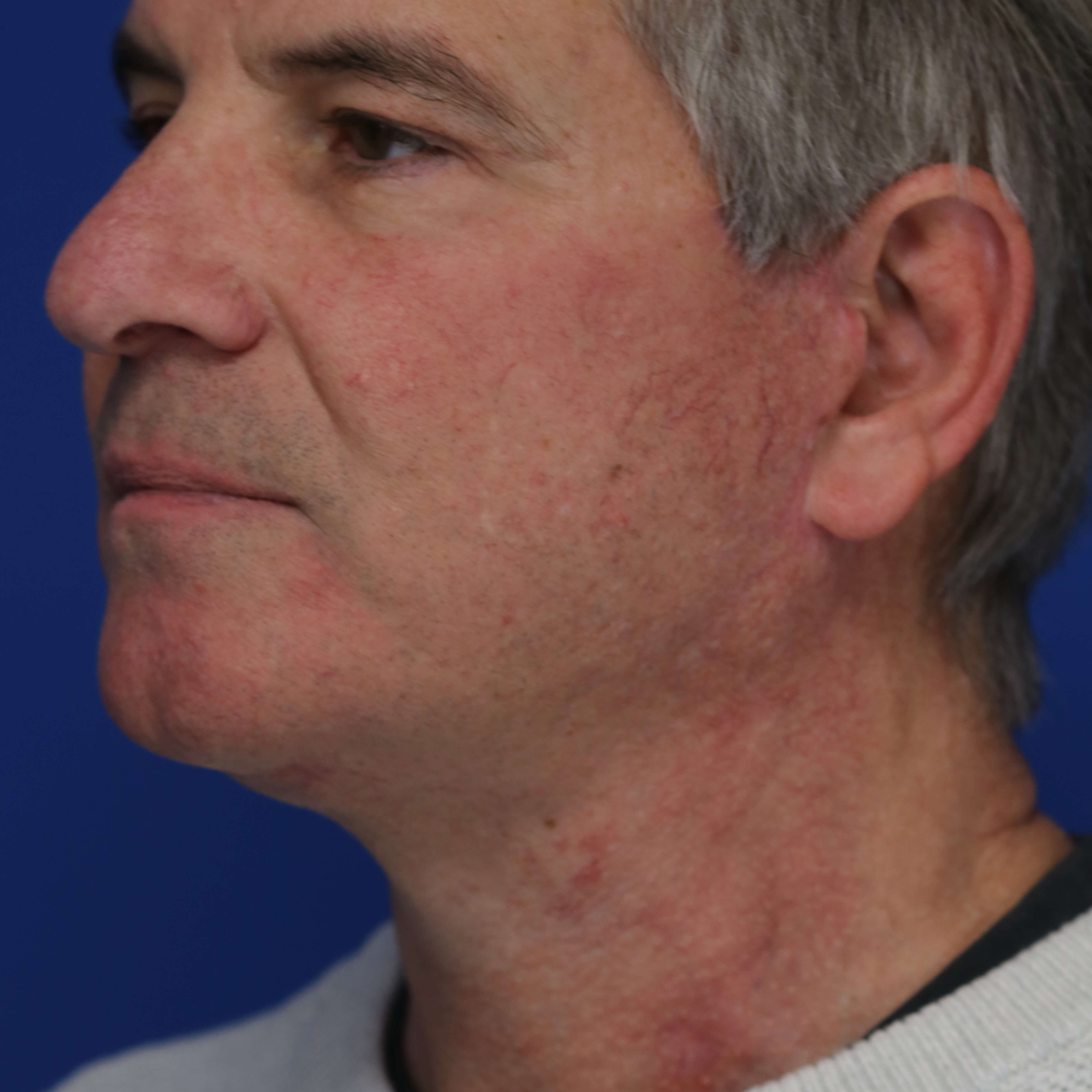 Male Short Scar Facelift